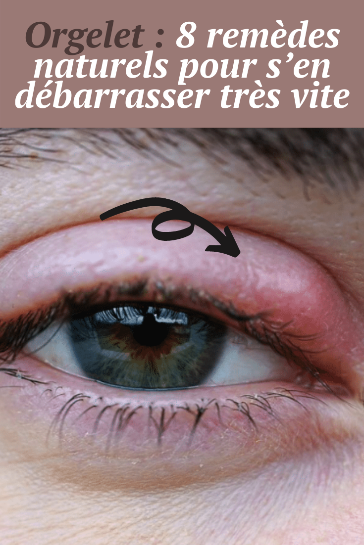 Rem&egrave;de naturel paupi&egrave;res gonfl&eacute;es